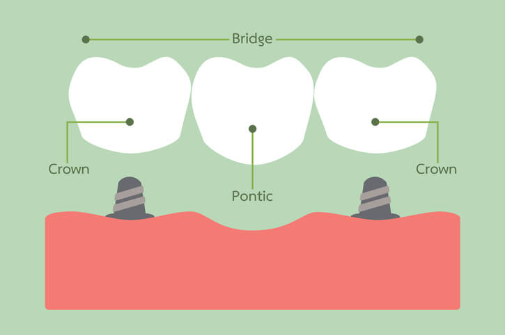 crown and bridges